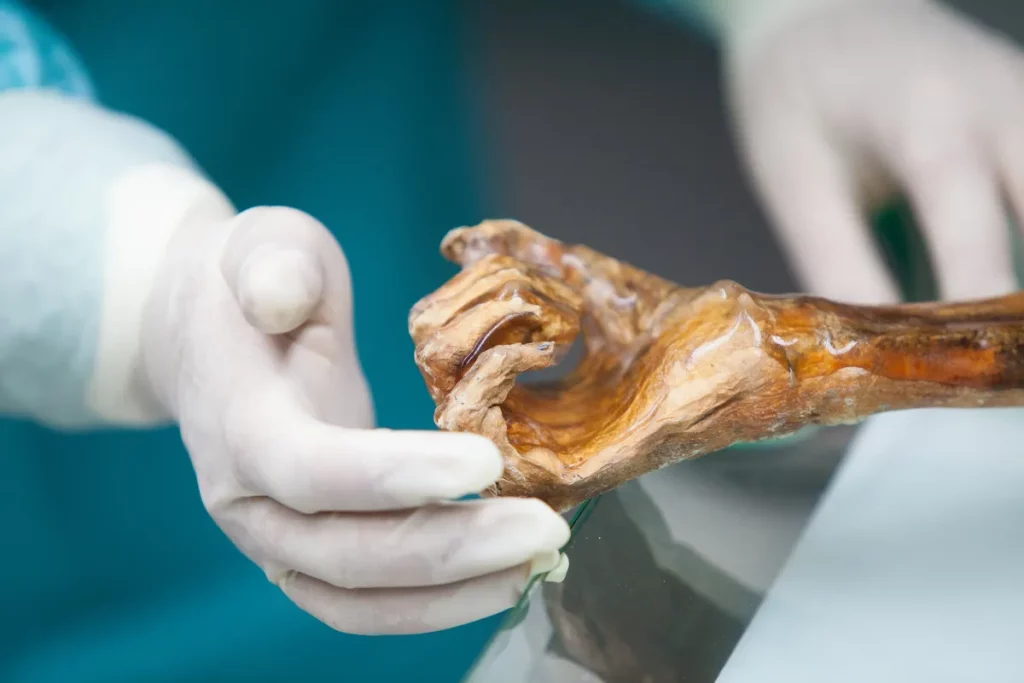 Mão mumificada de Ötzi o Homem do Gelo sendo examinada por cientistas. (Foto: phys.org)
